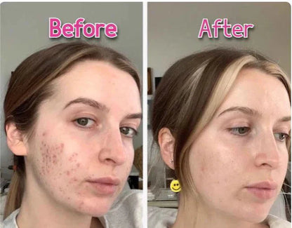 Before and after comparison of a person's face with visible acne treatment results.