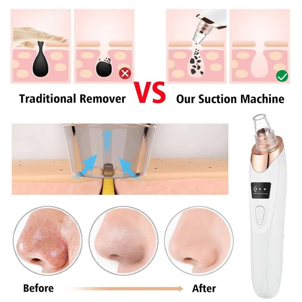 5 suction levels on rechargeable pore vacuum blackhead remover