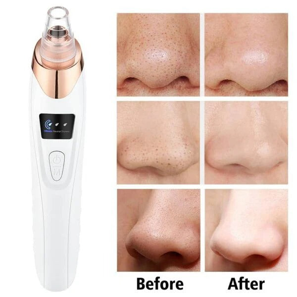 clear pores after using blackhead remover vacuum deep cleanser